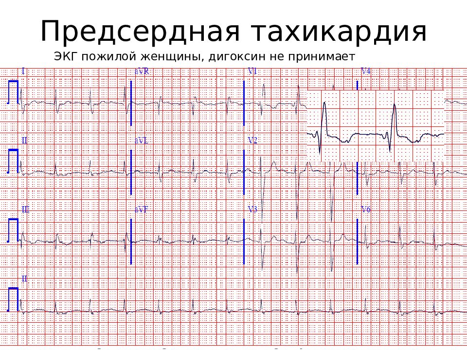 Тахикардия на экг