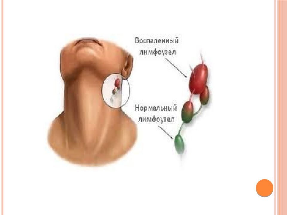 Как воспаляются лимфоузлы на шее расположение схема