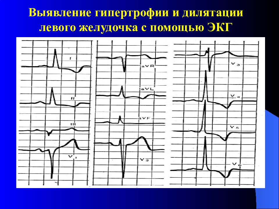 Причины гипертрофии левого желудочка. Перегрузка правых отделов сердца на ЭКГ. Укороченного ПКУ приобретенное на ЭКГ. Приобретенные пороки сердца презентация.