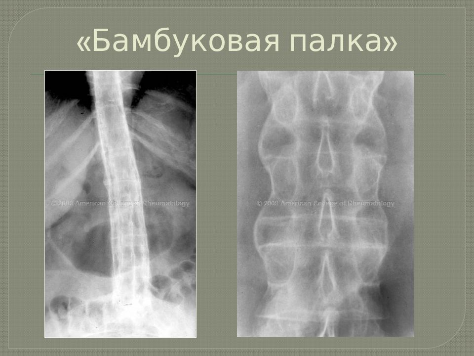 Анкилозирующий спондилит презентация