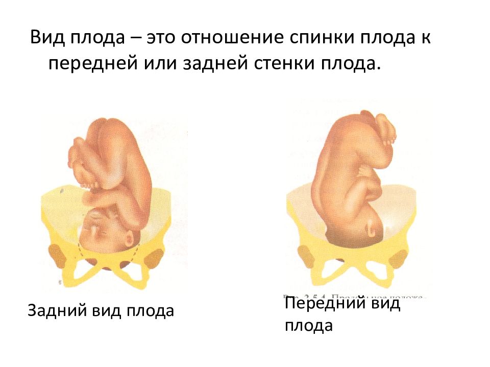 Тазовое предлежание плода акушерство презентация