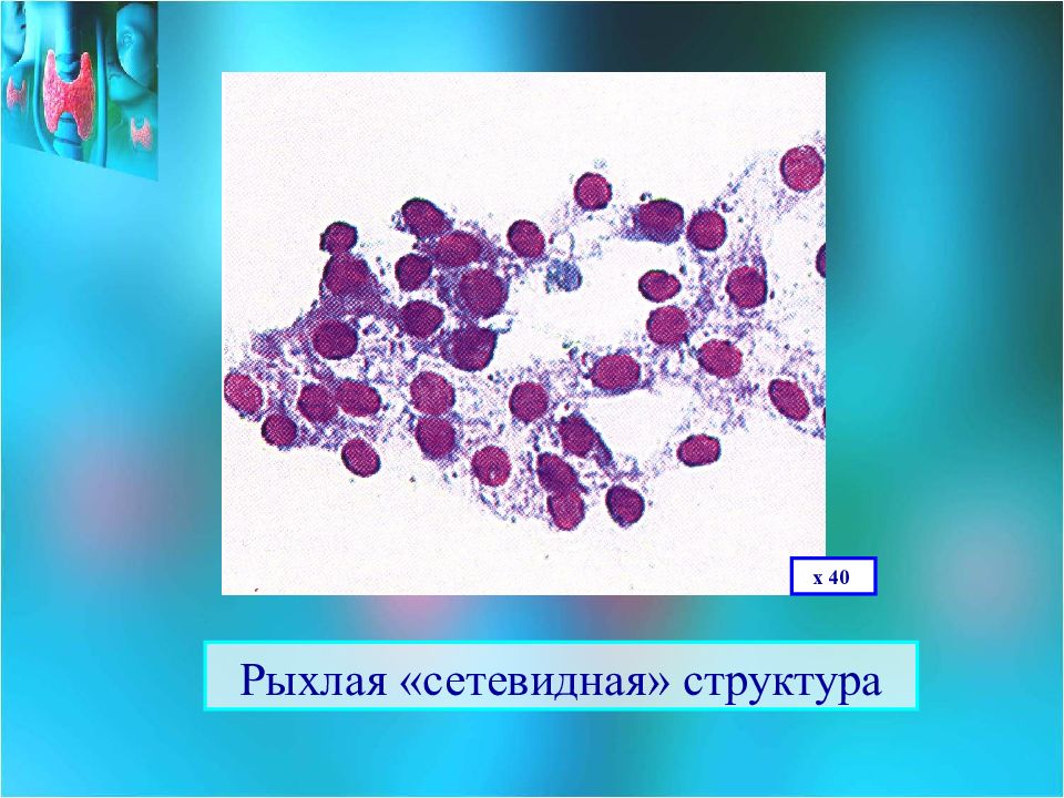 Цитологический атлас щитовидной железы. Рыхлая структура щитовидной железы что это такое. Цитологический атлас щитовидной железы Шапиро. Рыхлая структура.