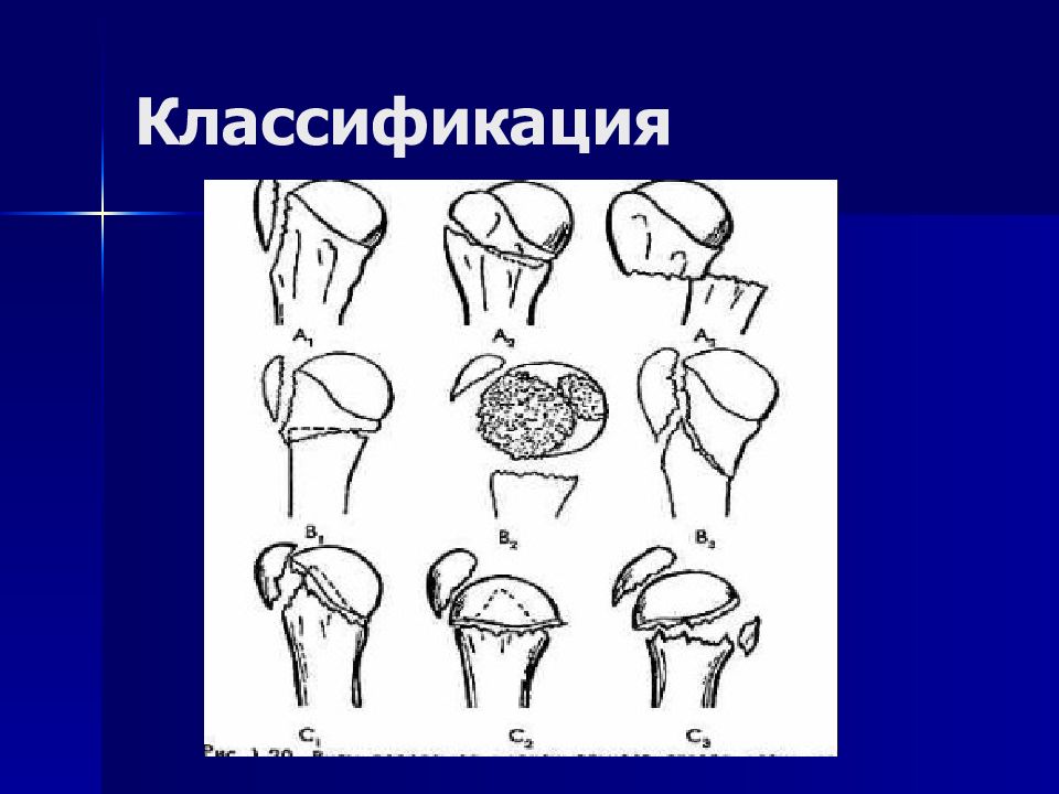 Классификация верхних конечностей. Классификация Neer. Классификация оан конечностей. Штыкообразная образная аномалия врожденная верхней конечности