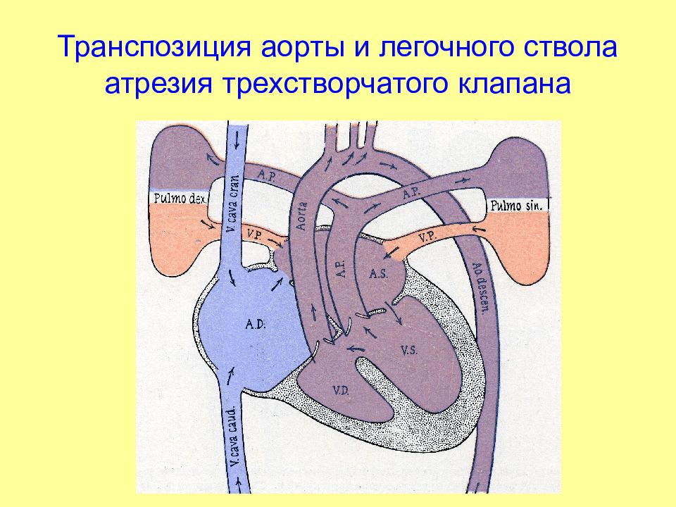 Атрезия трехстворчатого клапана презентация