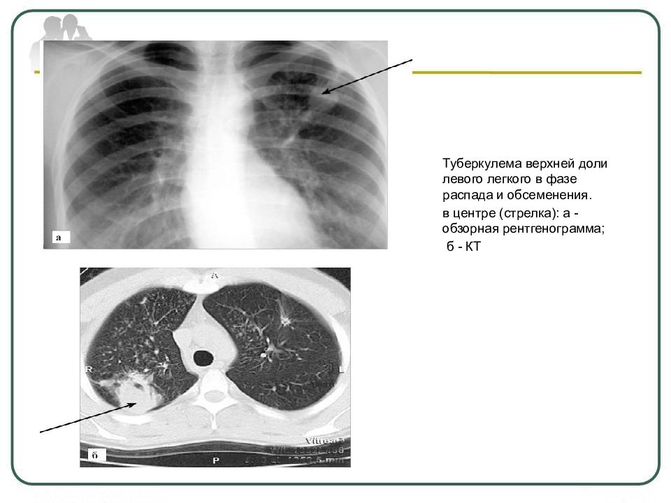 Туберкулома легких картинки