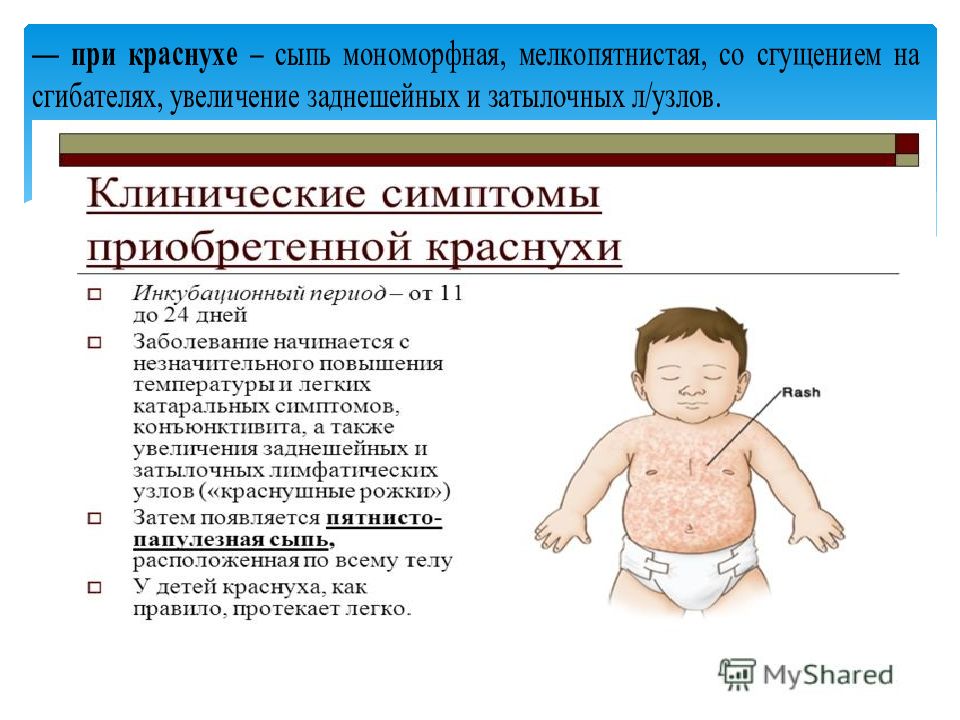 Корь и меры её профилактики