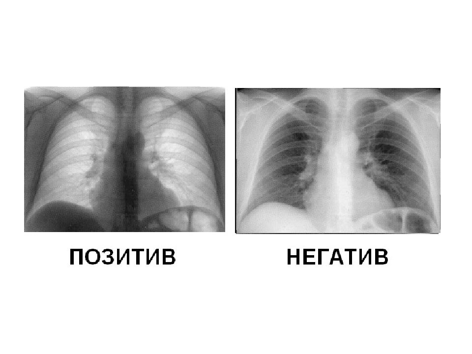 Негативное изображение рентген