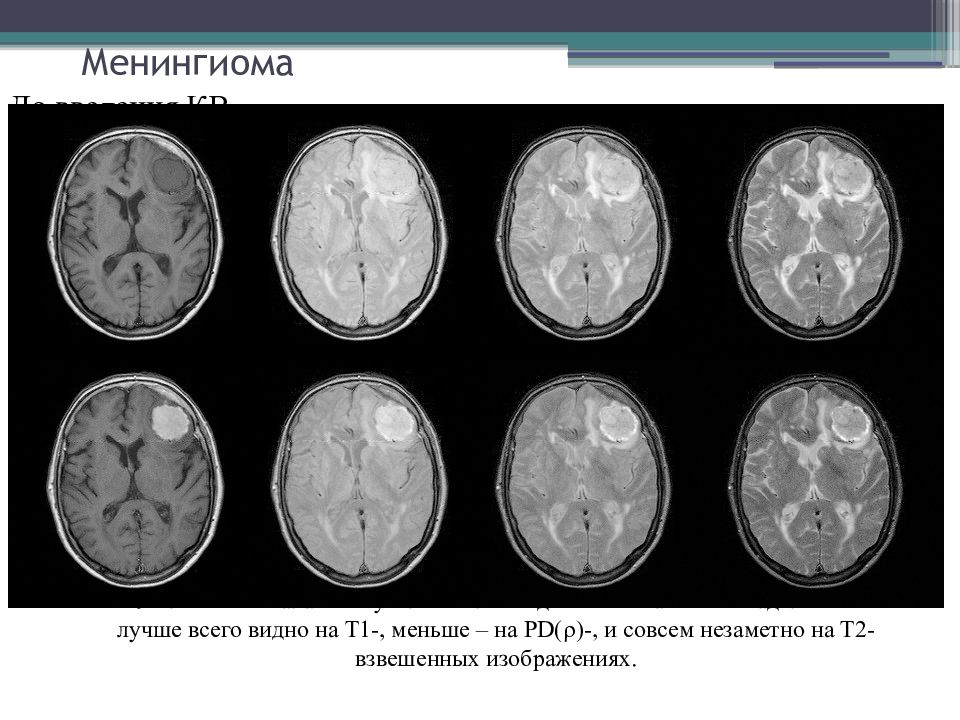 На т2 взвешенных изображениях при нативной магнитно резонансной томографии хорошо визуализируются