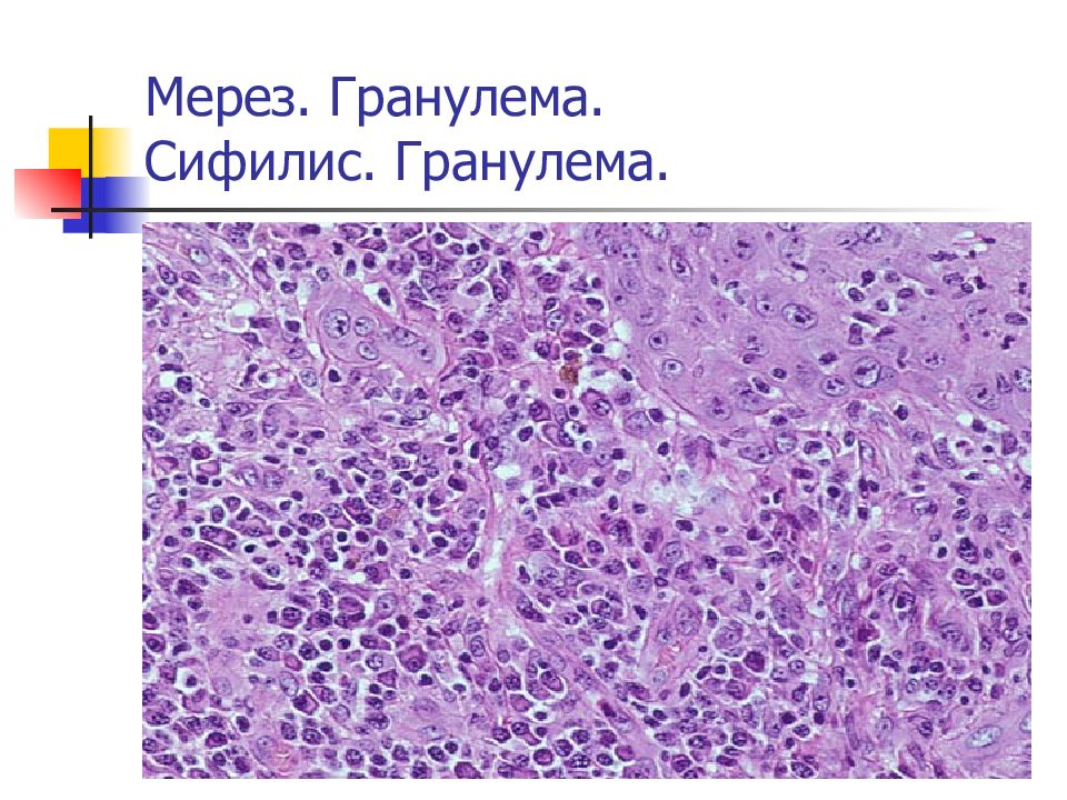 Туберкулезный менингит микропрепарат рисунок