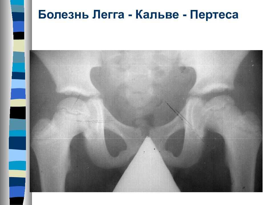 Болезнь пертеса. Кальве Пертеса рентген. Легга-Кальве-Пертеса у детей. Болезнь Кальве лега Пертерса.