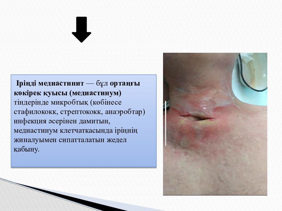 Тақырыбы: Іріңді медиастинит