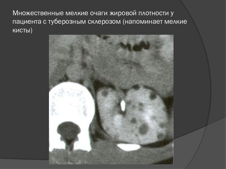 Мелкие очаги в легких на кт. Образование жировой плотности в легком на кт. Множественные мелкие очаги в легких на кт. Туберозный склероз легких кт.