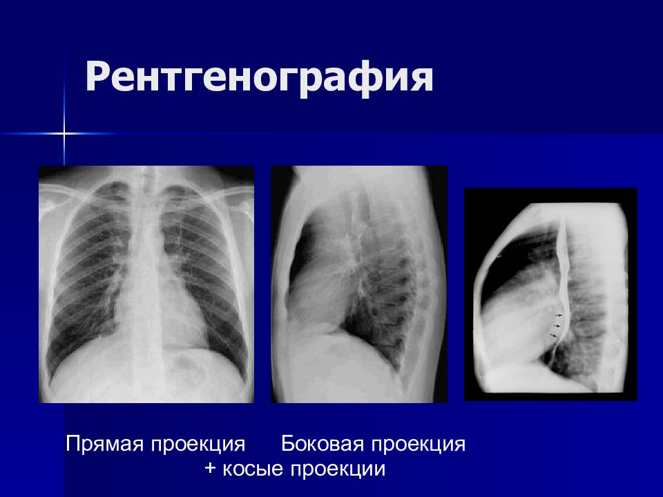 Косая проекция. Рентген ребер косая проекция. Левая косая проекция рентгенограмма. Проекция на ребра рентген.