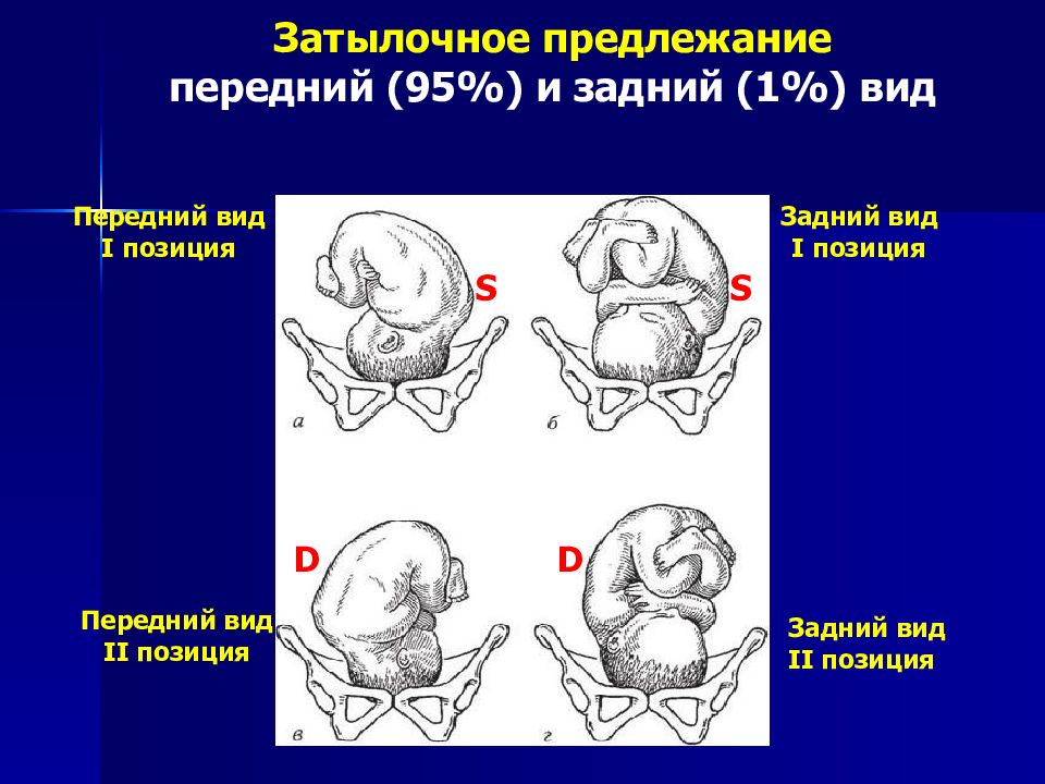 Виды затылочного предлежания