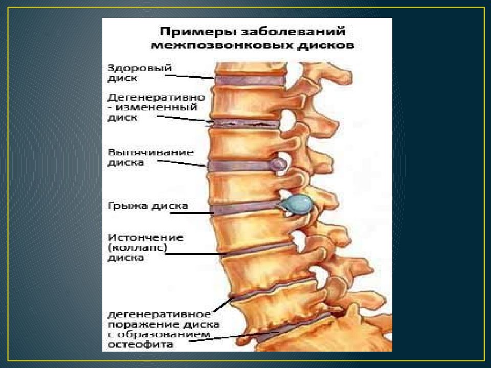 Карта вызова остеохондроз поясничного отдела позвоночника корешковый синдром