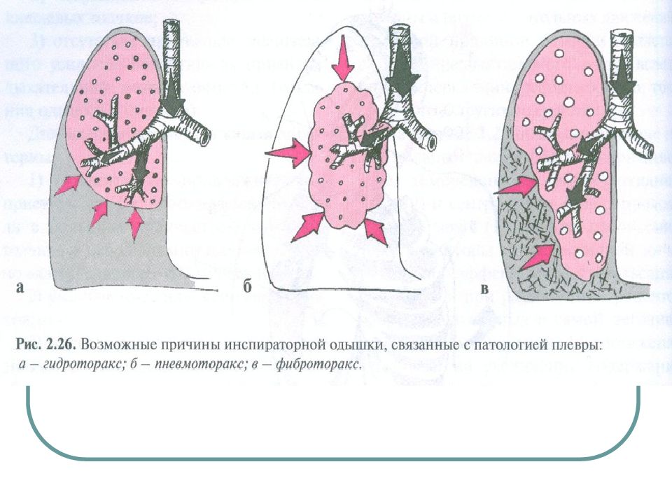 Гидроторакс легких