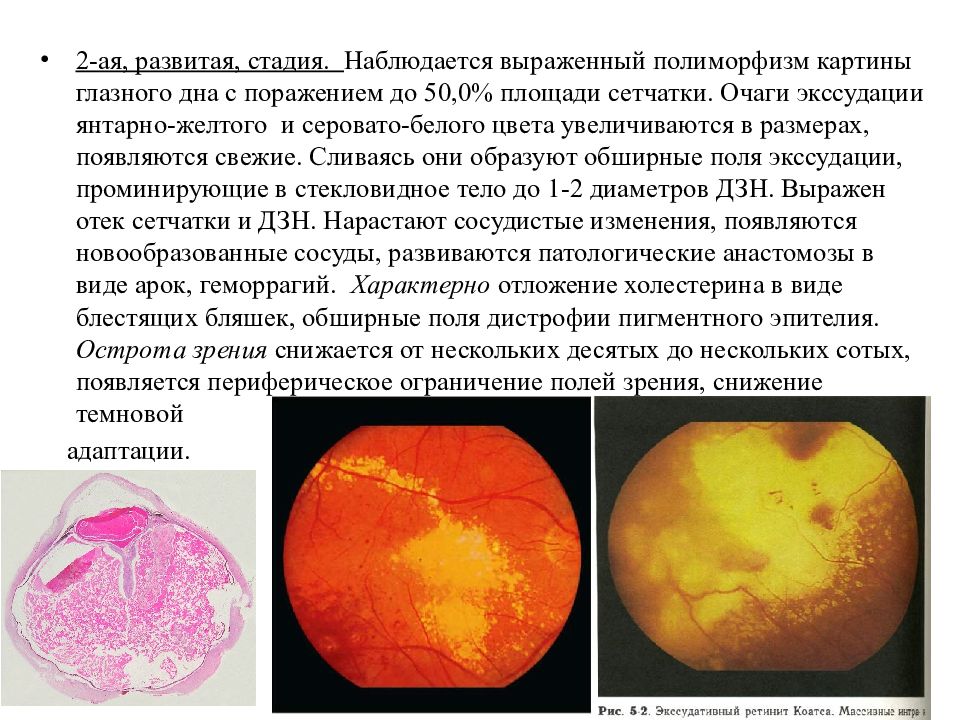 Пигментный ретинит презентация