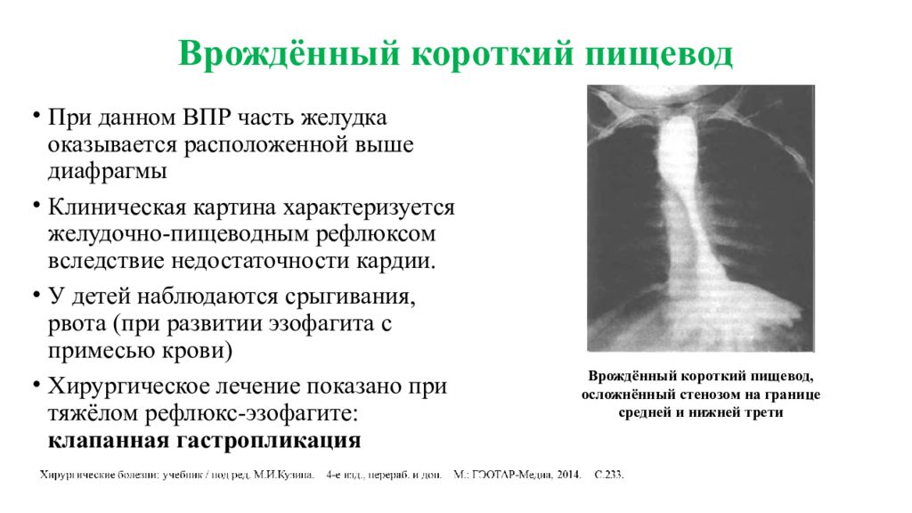 Синдром пищевода. Врожденный короткий пищевод рентген. Врожденный короткий пищевод патогенез. Короткий пищевод (врожденная аномалия). Короткий пищевод рентген.