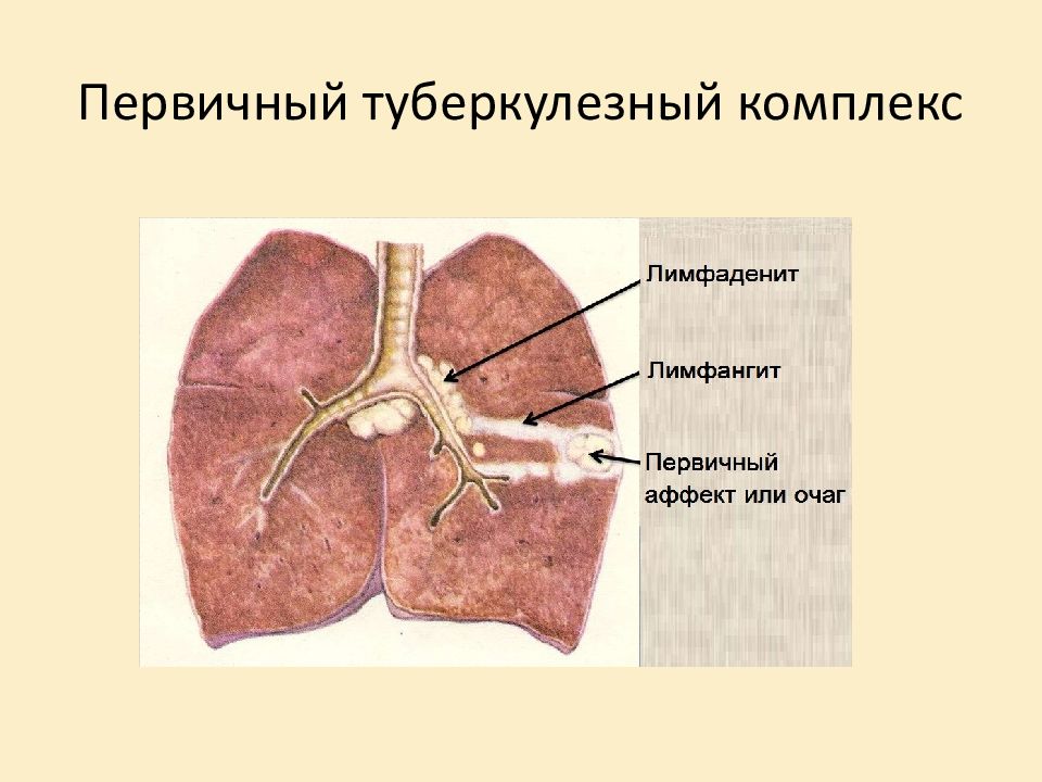 Первичный туберкулезный комплекс презентация