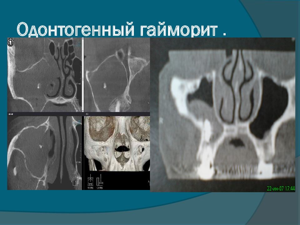 Одонтогенный гайморит картинки