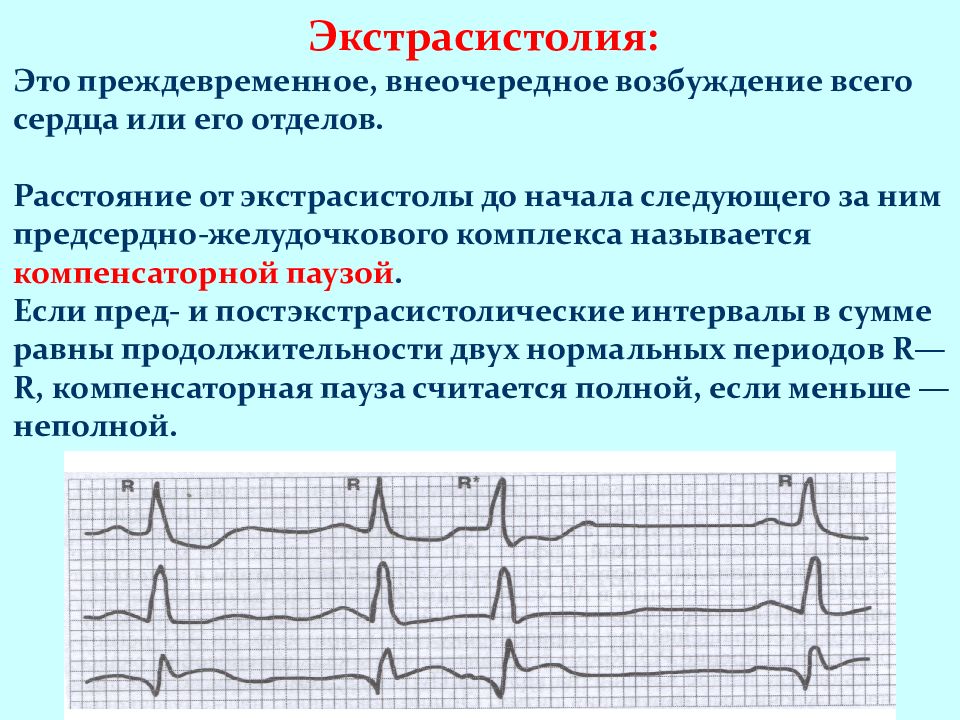 Экг при нарушениях ритма и проводимости презентация