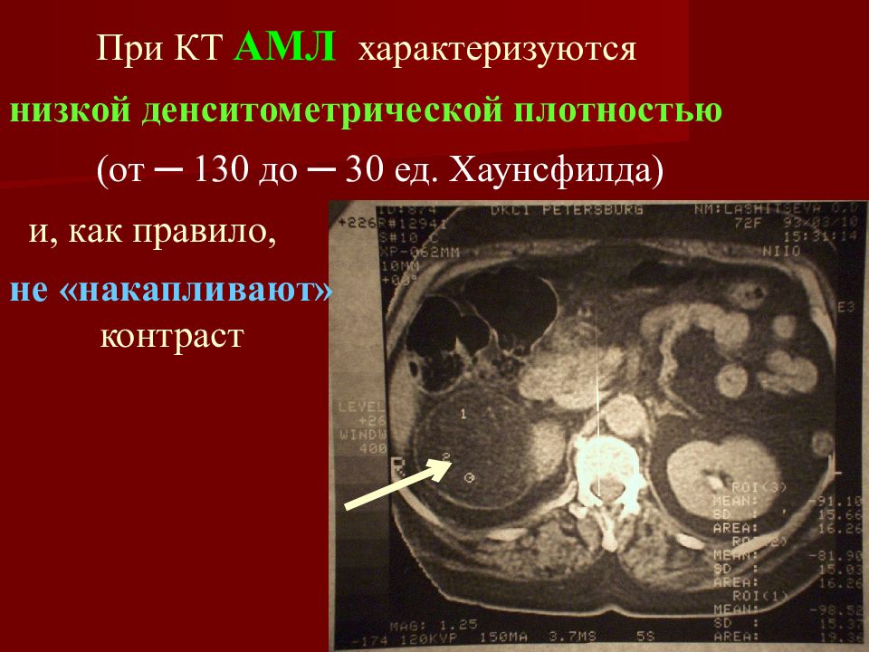 Светлоклеточный ракина кт. Плотность почки на кт. Светлоклеточный ракина кт. Диффузное поражение почек. Плотность почки на кт.