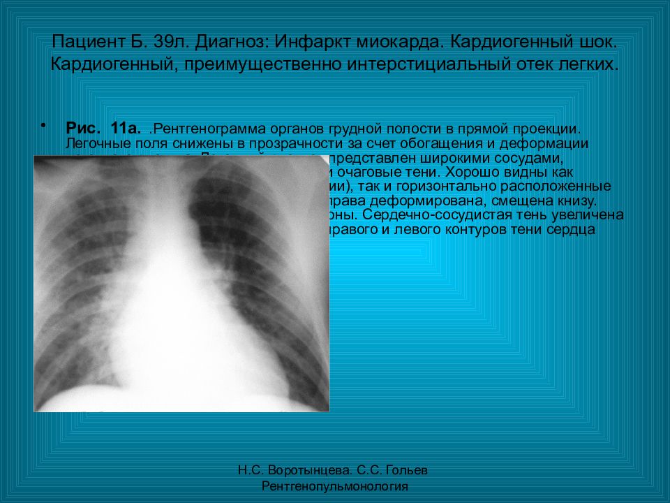 Интерстициальный легочный рисунок. Кардиогенный отек легких рентген. Рентген при кардиогенном отеке легких. Рентгенография грудной клетки при инфаркте миокарда. Рентгенограмма при инфаркте миокарда.