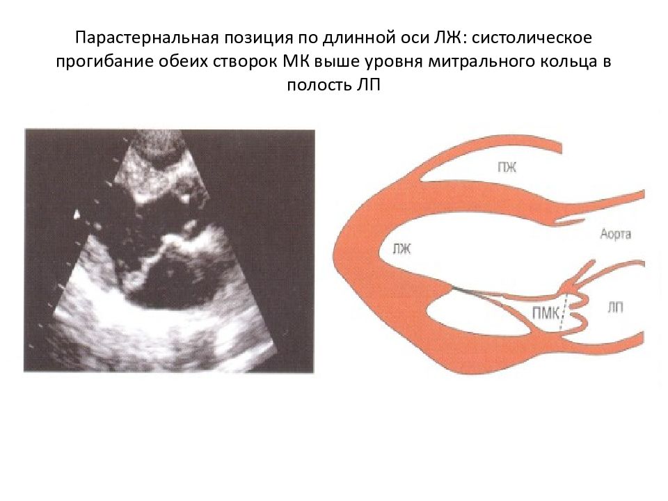 Длинная ось. Парастернальная позиция длинная ось. Парастернальная позиция по длинной оси. Парастернальная ось позиция по длинной оси. Парастернальная позиция длинная ось левого желудочка.