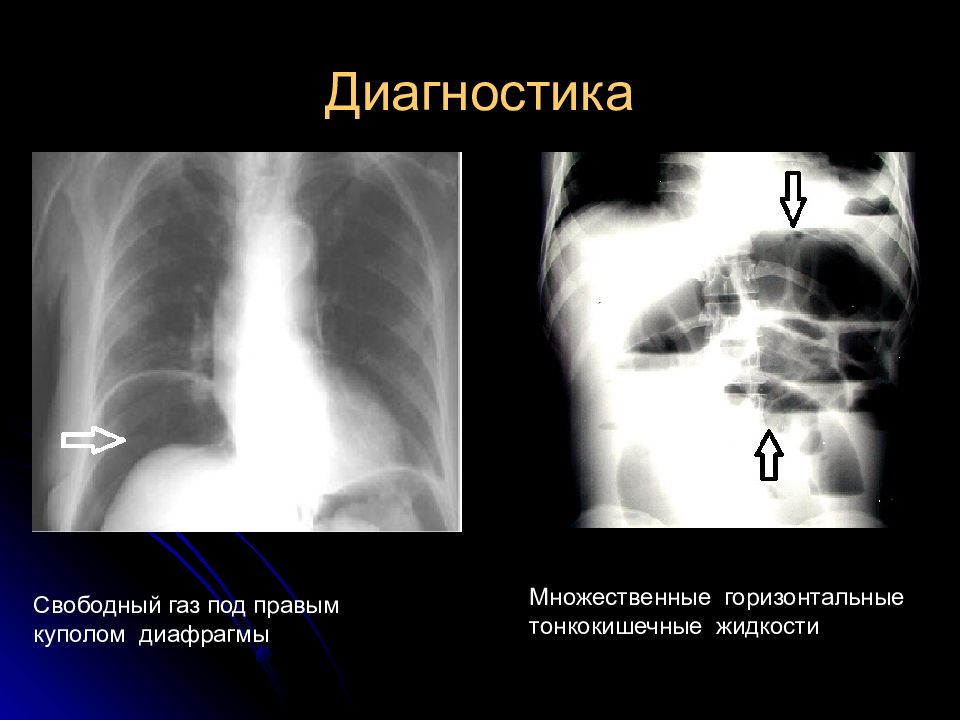 Диагностика перитонита презентация