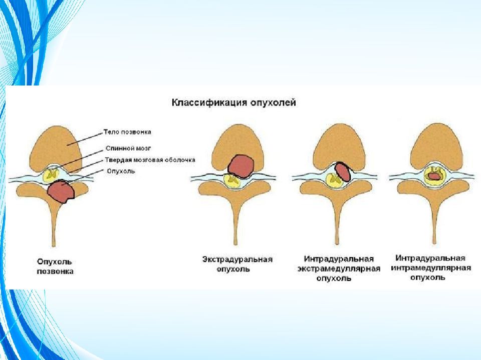 Опухоли спинного мозга презентация