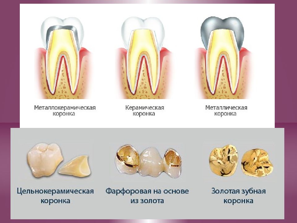 Изготовление пластмассовых коронок презентация