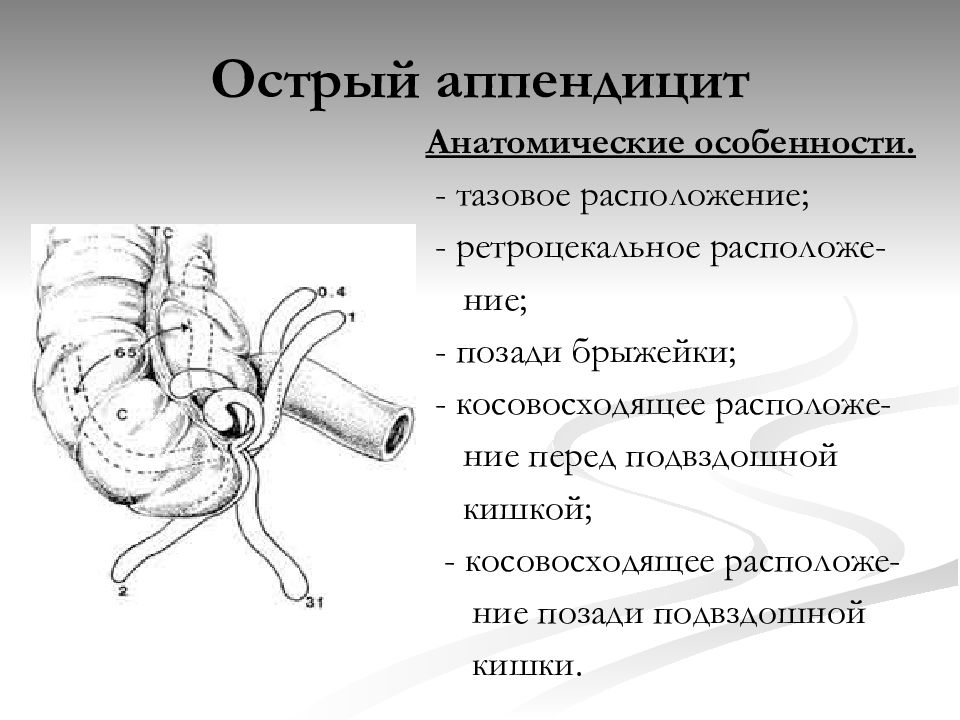 Особенности клинической картины острого аппендицита при тазовом расположении червеобразного отростка