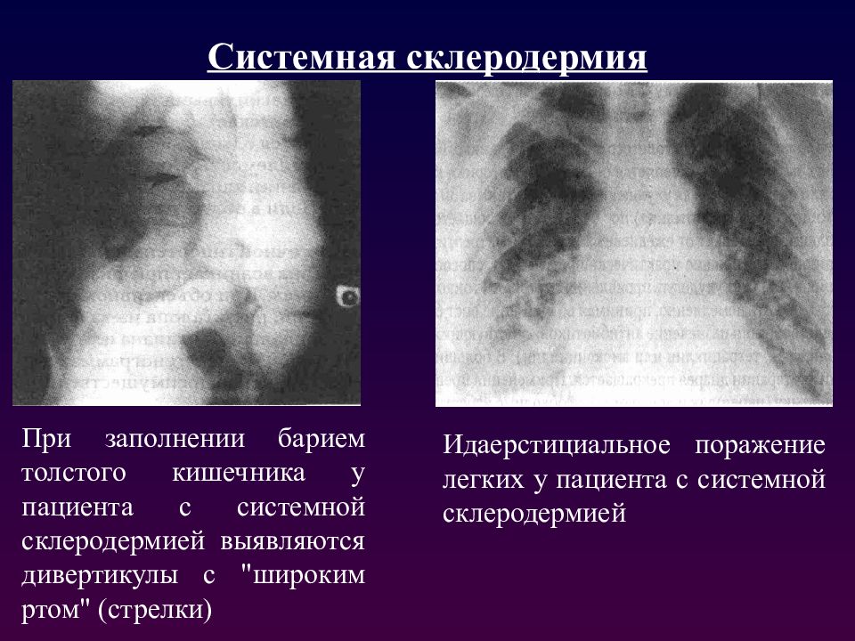 Системная склеродермия. Склеродермия поражения системная поражения. Поражение легких при системной склеродермии. Паранеопластическая склеродермия. Поражение ЖКТ при системной склеродермии.