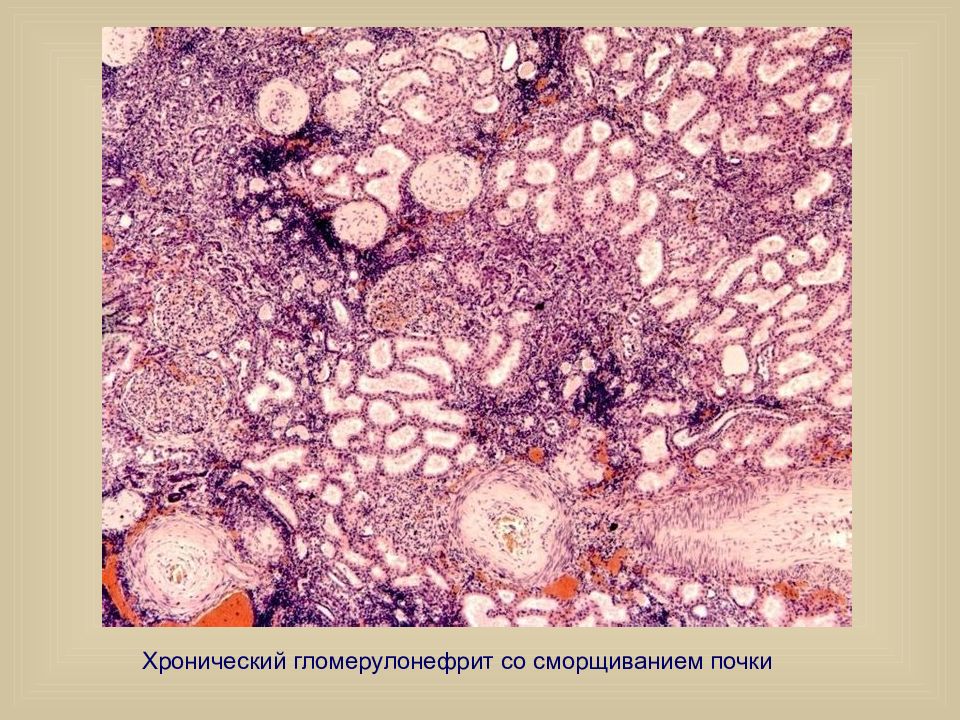 Микроскопическая картина мочи при гломерулонефрите