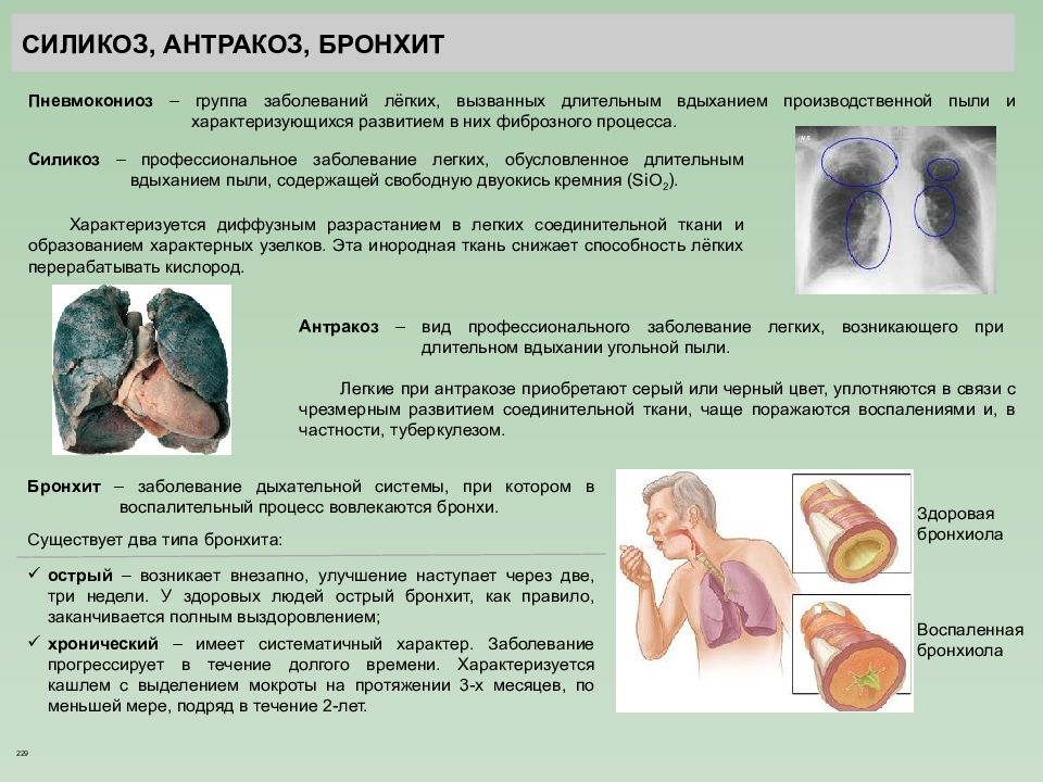 Силикоз. Антракоз профессиональное заболевание. Силикоз-Антракоз легкого.