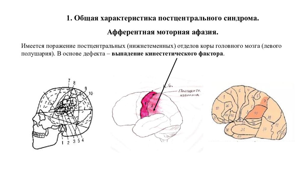 Афферентная моторная афазия нарушения. Афферентная моторная афазия локализация очага поражения. Поражение мозга при моторной афазии. Очаг поражения при афферентной моторной афазии. Синдром афферентной моторной афазии.