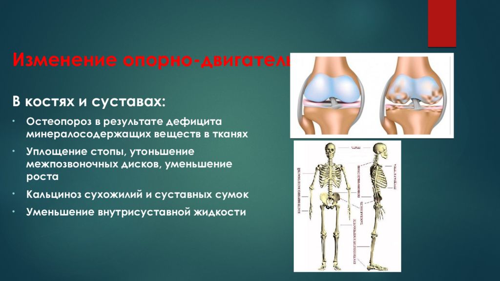 Указанные изменения. Остеопороз опорно-двигательного аппарата. Старение опорно-двигательного аппарата. Опорно двигательный аппарат кости суставы. Факторы заболеваний опорно-двигательной системы.