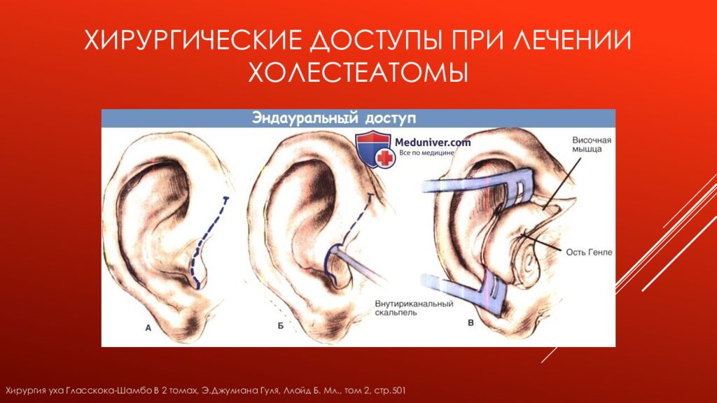 Холеастома. Тимпанопластика уха холестеатома. Холестеатома среднего уха операция. Холеастома уха операция. Холестеатома среднего уха рецидив.