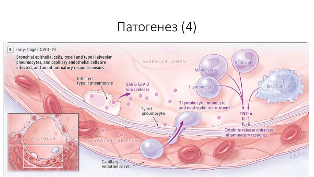 Тяжелое течение covid. Ковид этиология патогенез. Патогенез Covid-19. Этиология ковид 19. Патогенез коронавируса.