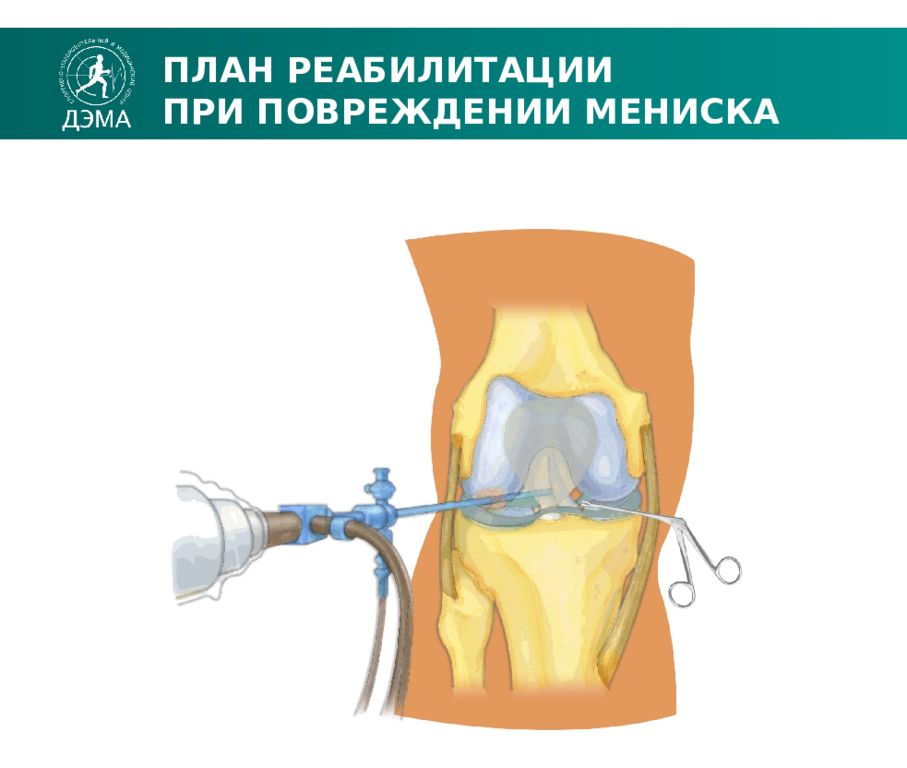 Уровень мениска. Мениск коленного сустава. Упражнения при разрыве мениска коленного сустава. Мениск выкачивание жидкости.