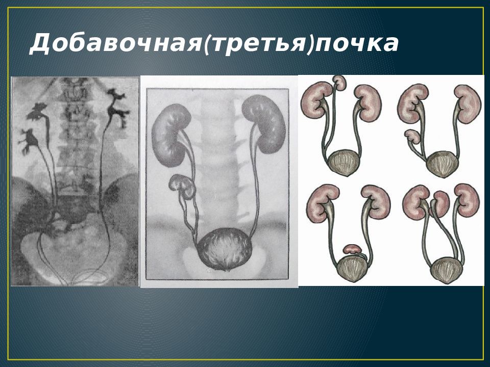 Аномалии мочеполовой системы презентация