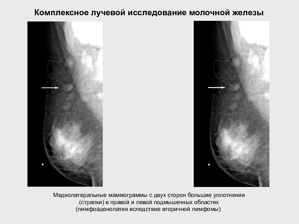 Уплотнение железы. Квадранты молочной железы на маммограмме. Лимфома молочной железы. Заболевания молочной железы презентация. Большие уплотнения в молочных железах.