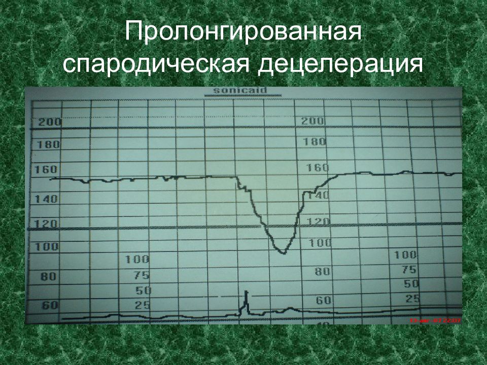 Ктг баллы. Децелерации на КТГ. Поздние децелерации. Децелерации спорадические децелерации. Вариабельные децелерации на КТГ.