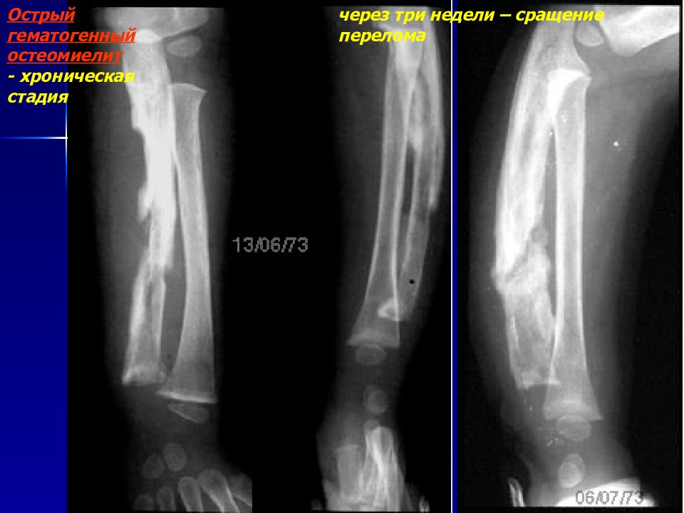 Гематогенный остеомиелит кт. Хронический остеомиелит рентген. Остеоперфорация остеомиелит. Острый гематогенный остеомиелит остеоперфорация.