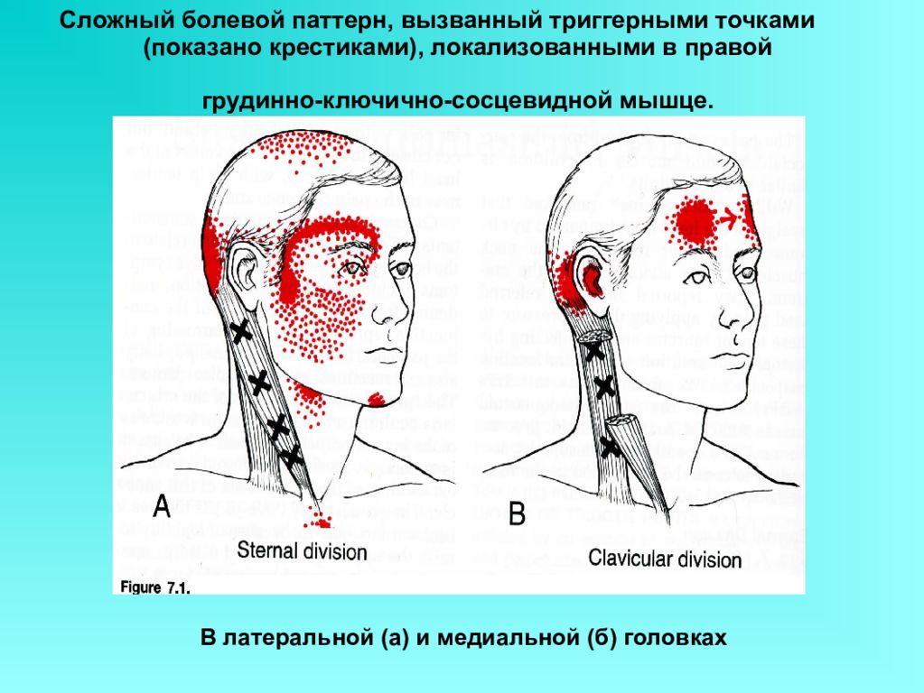 Точки напряжения мышц. Сосцевидная мышца. Триггерные точки грудино ключично сосцевидной мышцы. Триггерные точки мышц головы и шеи. Укорочение грудино-ключично-сосцевидной мышцы.