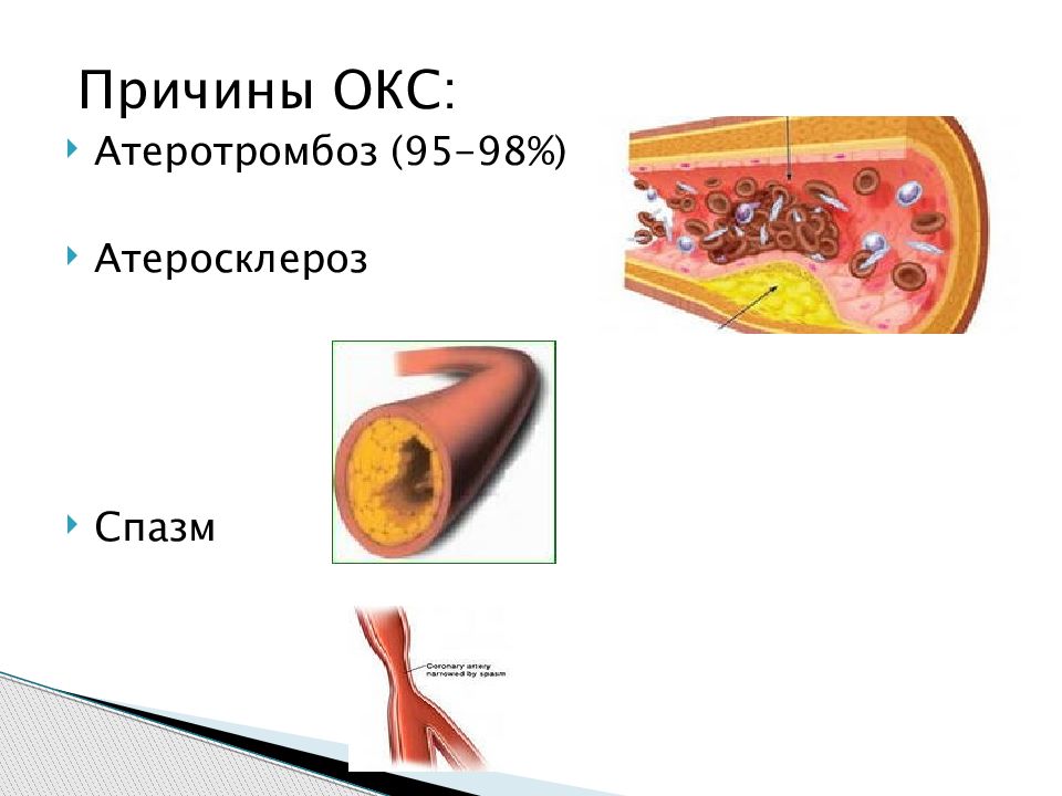 Коронарный атеросклероз. Острый коронарный синдром причины. Атеросклероз и Атеротромбоз. Острый коронарный синдром картинки.