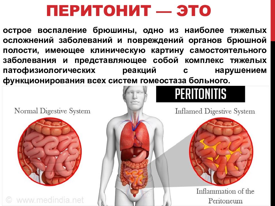 Перитонит симптомы