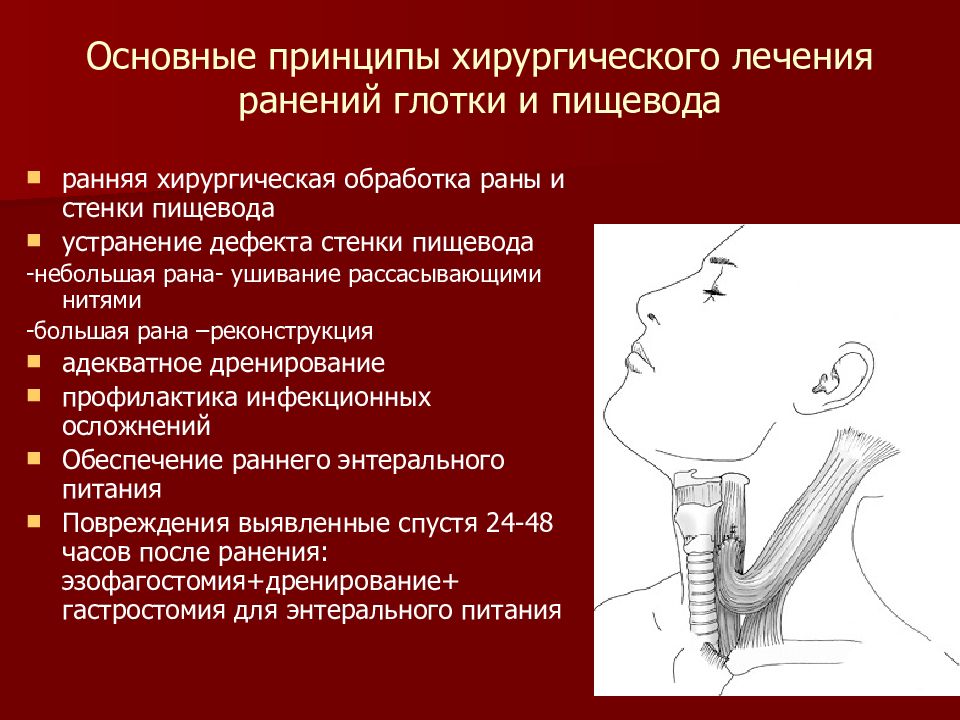 Ранения лечение. Ранение шейного отдела пищевода. Ушивание раны пищевода.