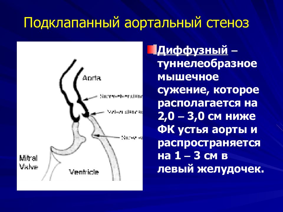 Что такое стеноз. Надклапанный клапанный подклапанный аортальный стеноз. Клапанный подклапанный надклапанный стеноз аорты. Подклапанный стеноз аортального клапана. Аортальный стеноз надклапанный клапанный.