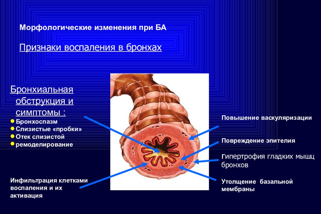 Бронхиальная обструкция. Морфологическом изменение в бронхах. Железы бронхов. Морфологические изменения при воспалении бронхов. Морфологические изменения в бронхах при ба.
